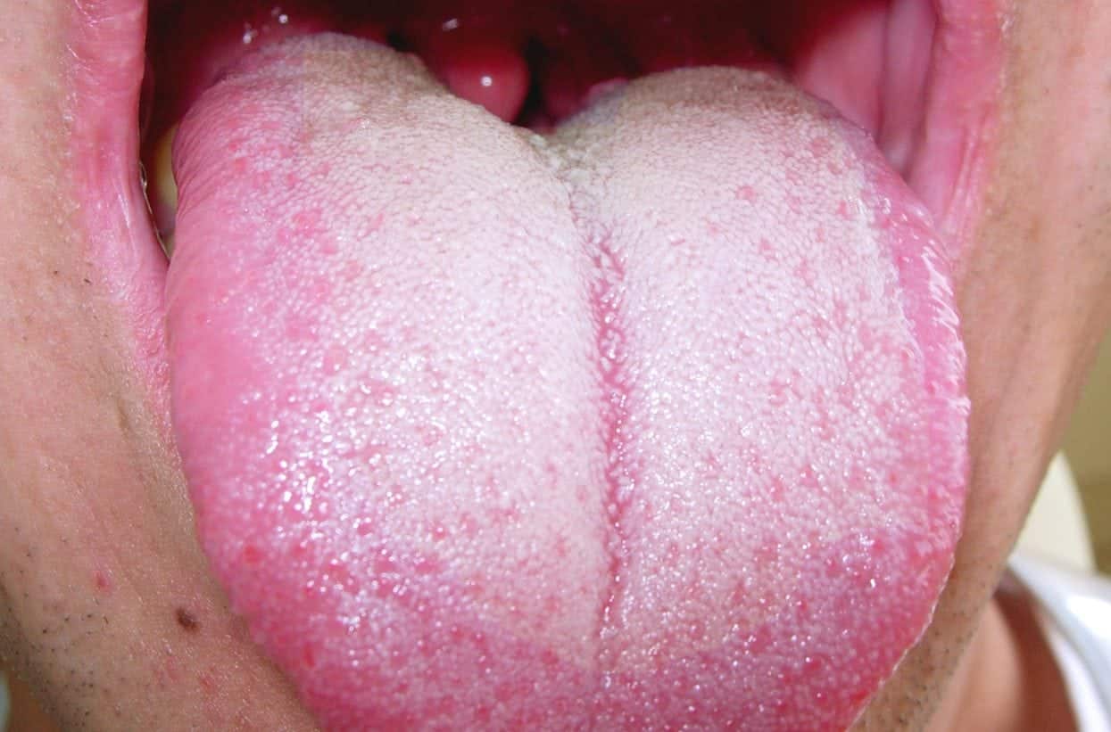 O Que Pode Comer Quando Coloca Piercing