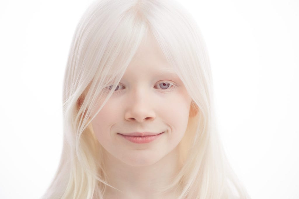 Blog Da Giovanna Albinismo Causas Sintomas Tratamentos E Riscos Da Hot Sex Picture