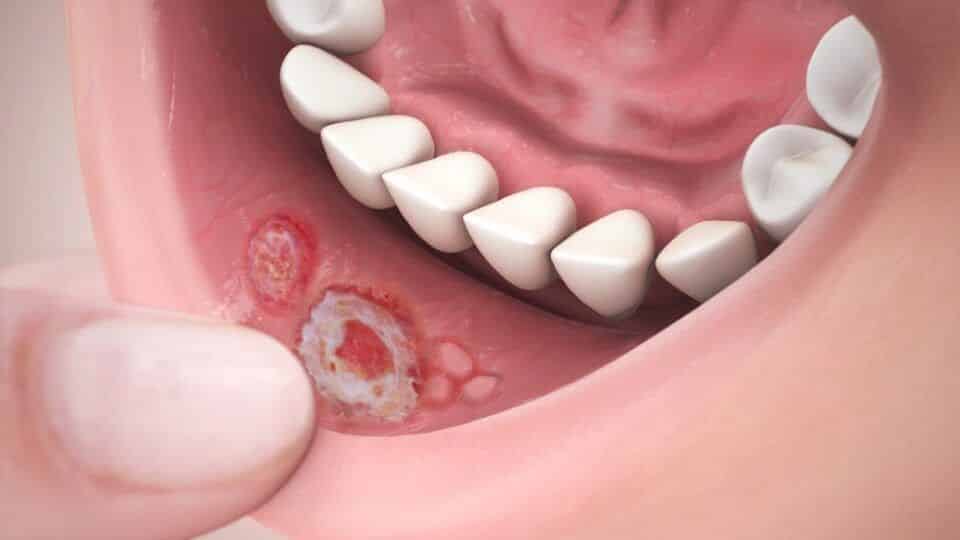 O que é afta Causas sintomas prevenção e diferenças de herpes labial