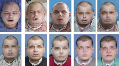 Como está o homem que recebeu o maior transplante de rosto?
