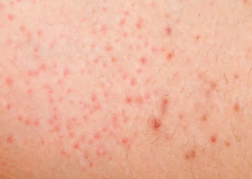 Foto em zoom de bolinhas no braço causada por foliculite