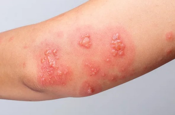 Foto de bolinhas no braço causadas por herpes-zóster