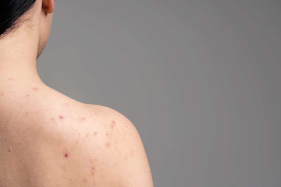 Foto de mulher de costas com ombro cheio de bolinhas causadas por acne