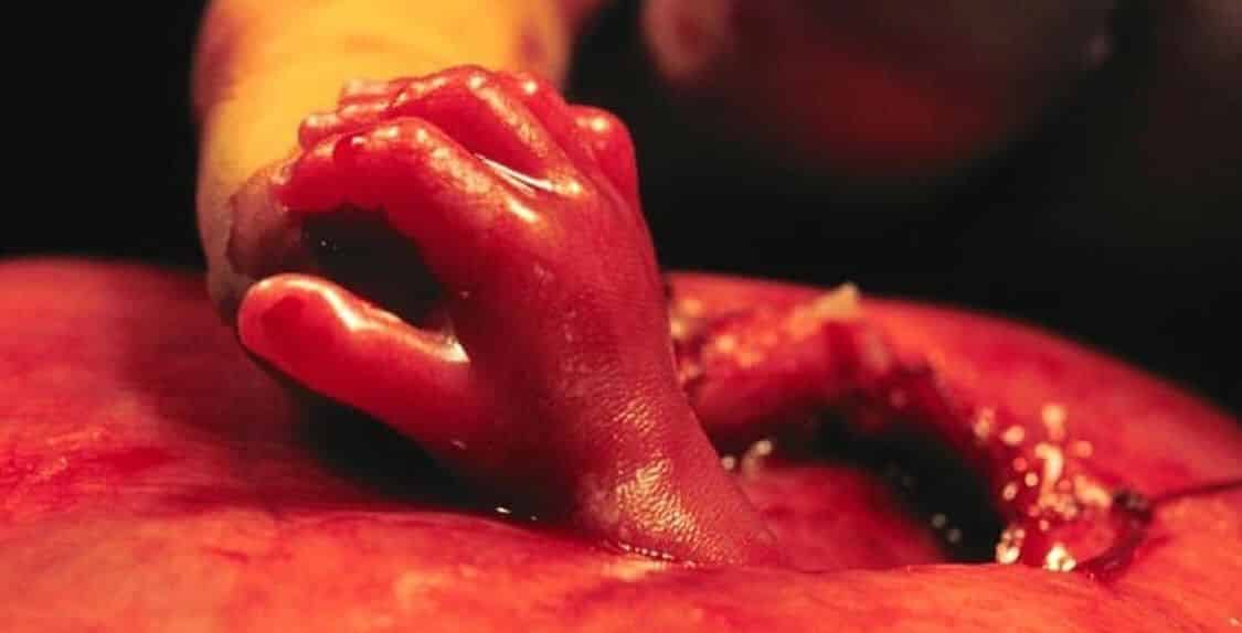 16 anos depois, assim ficou o bebê que agarrou a mão do médico dentro do útero