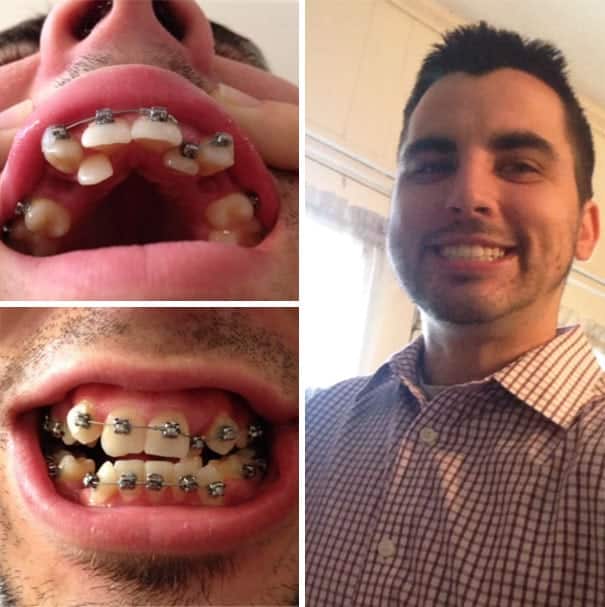 Featured image of post Dente Encavalado Quanto Tempo De Aparelho Ol tenho 22 anos quanto tempo dura em media para o dente da frente ficar alinhado com o aparelho