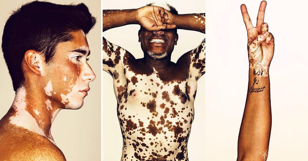 O que é vitiligo? | Dra. Kaliandra Cainelli