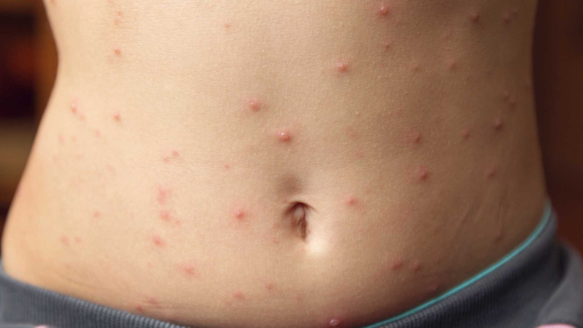7 sintomas de sarampo para reconhecer a doença