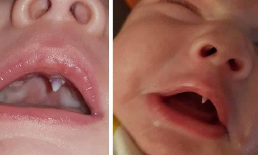 Bebê nasce com presa de vampiro e causa espanto na internet