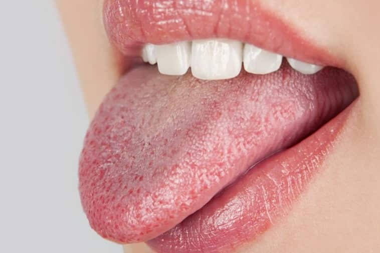O que é boca seca, como saber se você tem e qual o tratamento