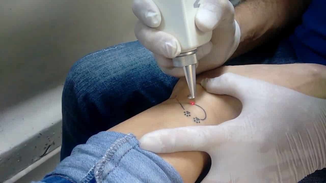 Entenda mais sobre o processo de remoção de tatuagem