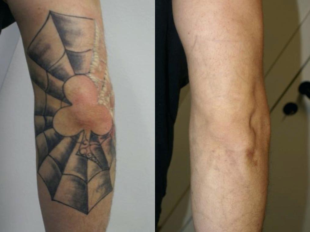 Entenda mais sobre o processo de remoção de tatuagem