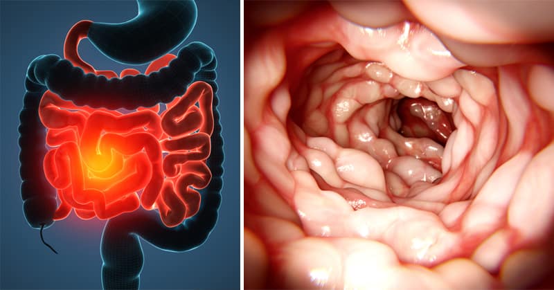 O que é, quais os sintomas e os tratamentos da Doença de Crohn