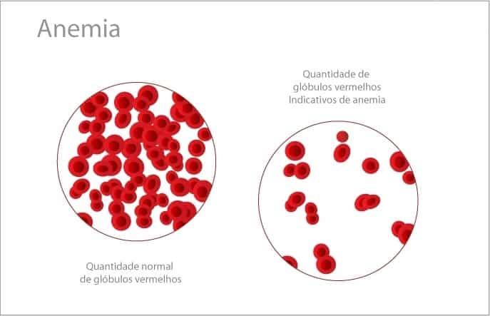 Você conhece quais são os sintomas de anemia?