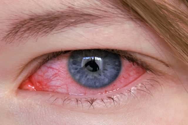 Olhos vermelhos - 10 causas mais comuns do problema