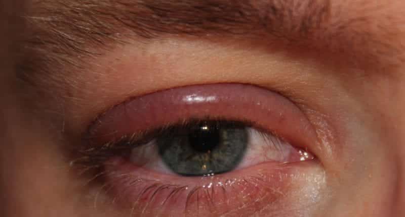 Olhos vermelhos - 10 causas mais comuns do problema