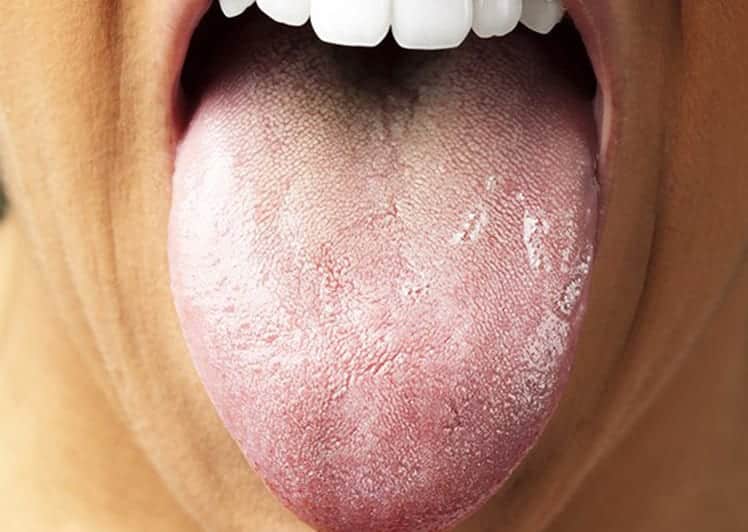 Saburra Lingual - o que é e como acabar para ter uma boca saudável