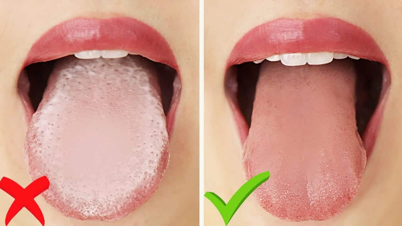 Língua branca pode ser um sinal de doença ou apenas má higiene bucal?
