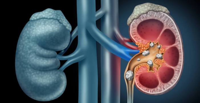 Pedra nos rins - Causas, sintomas e tratamentos para o cálculo renal