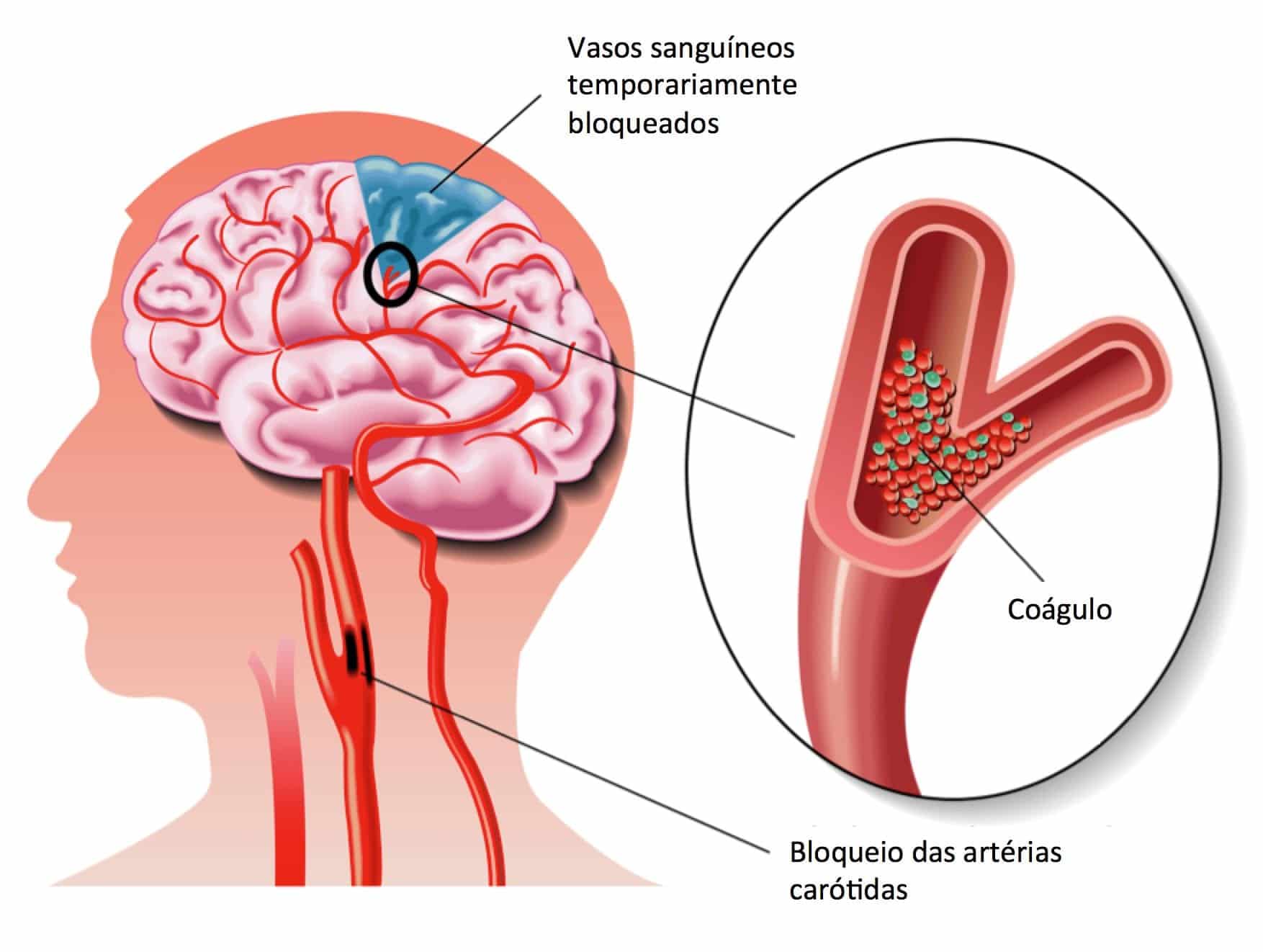 Sinais de AVC - como identificar e prevenir o acidente vascular cerebral