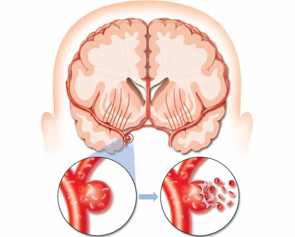 Blog da Giovanna Sinais de AVC Como identificar tipos e prevenção