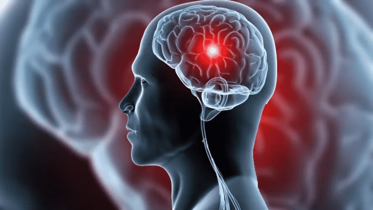 Sinais de AVC - como identificar e prevenir o acidente vascular cerebral
