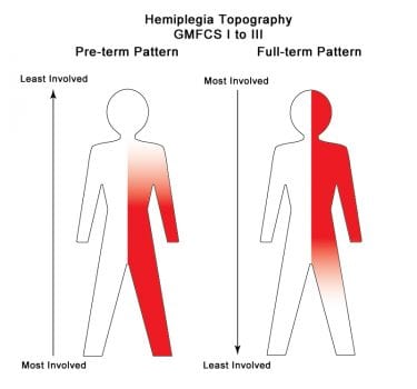 Hemiplegia, o que é? Causas, classificações, sintomas e tratamento