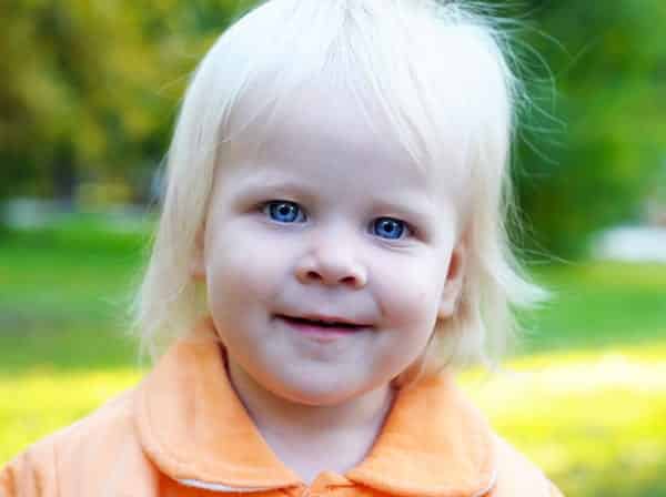 Albinismo - causas, sintomas, tratamentos e riscos da condição