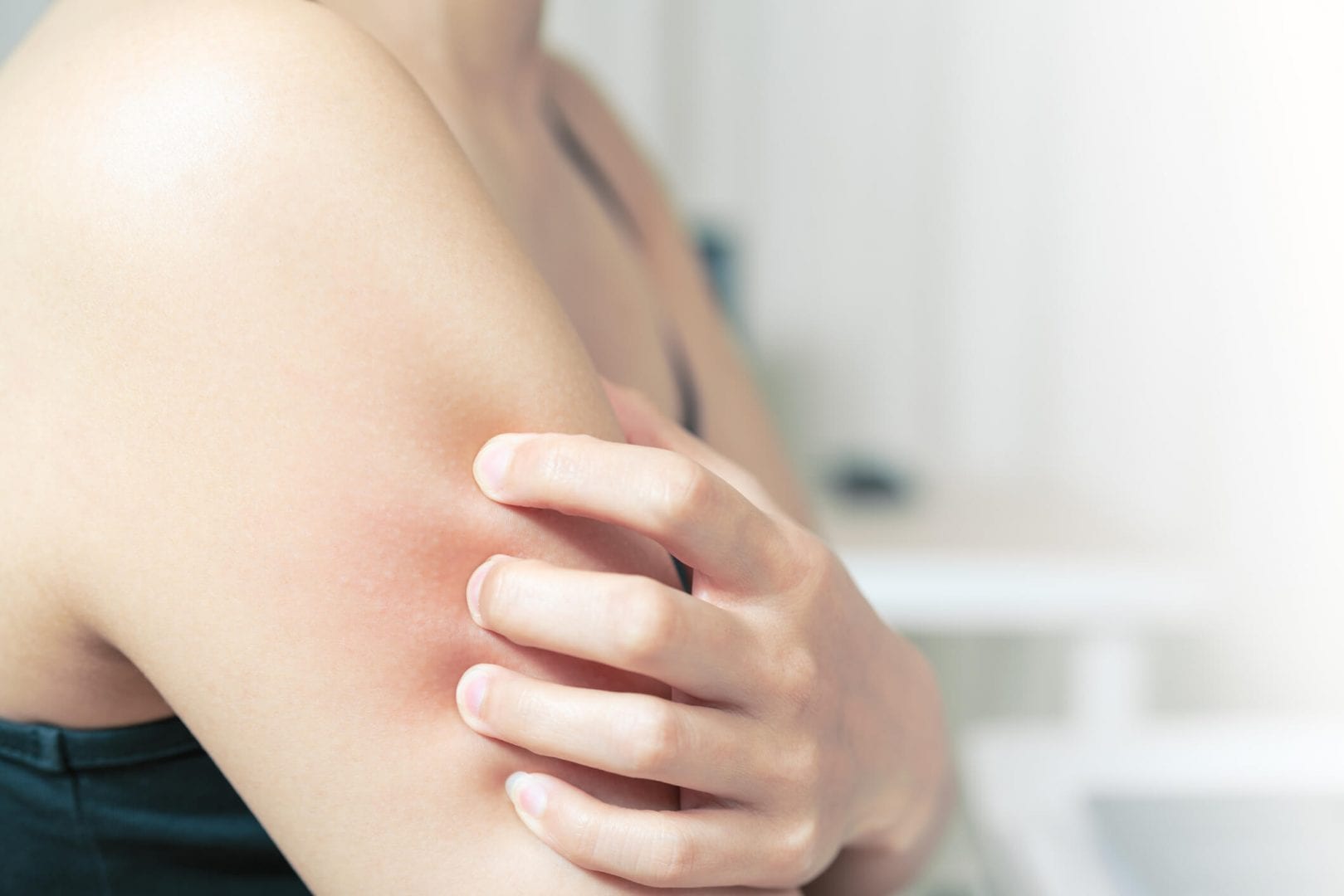 Alergias na pele - o que é, o que causa e como tratar