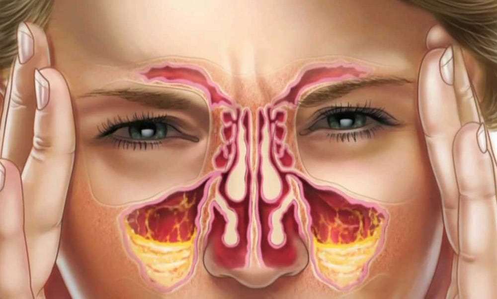 Sinusite - 12 remédios caseiros para aliviar sintomas