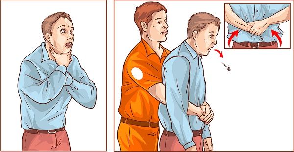 Manobra de Heimlich - como fazer e em que situações de asfixia utilizar