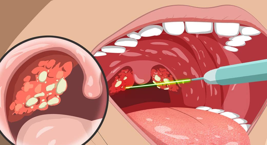 Bolinhas brancas na garganta: o que são, sintomas, causas e tratamento