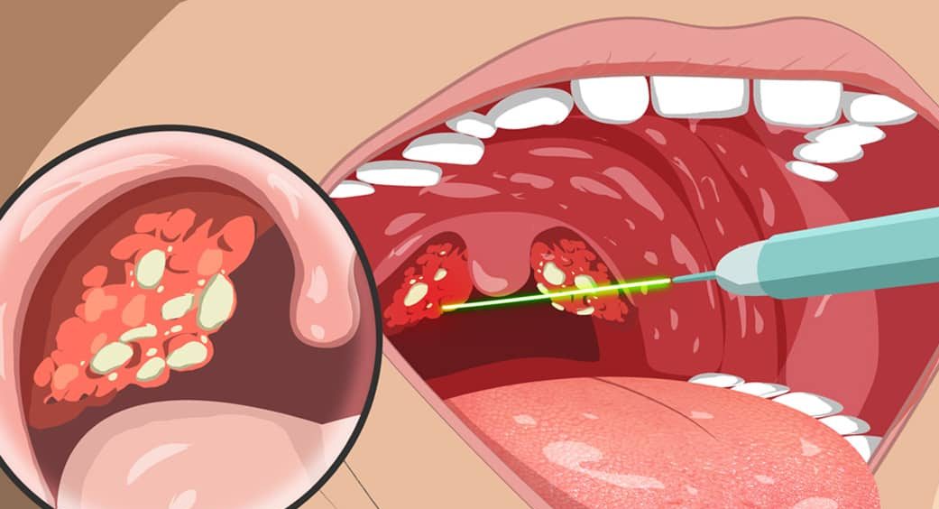 Você sabe o que são aquelas bolinhas fedidas que aparecem na garganta? -  Mega Curioso