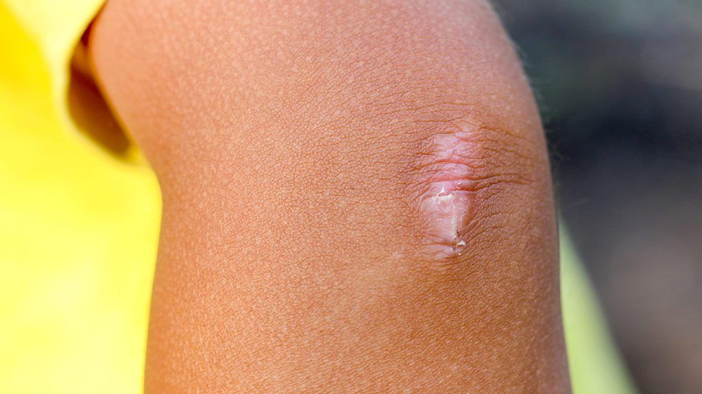 Curar uma ferida - dicas essenciais para uma cicatrização saudável