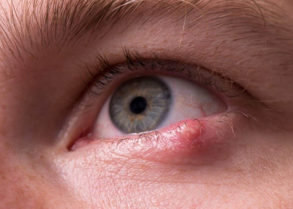 Pálpebras inchadas: causas e tratamento para inchaço ao redor dos olhos
