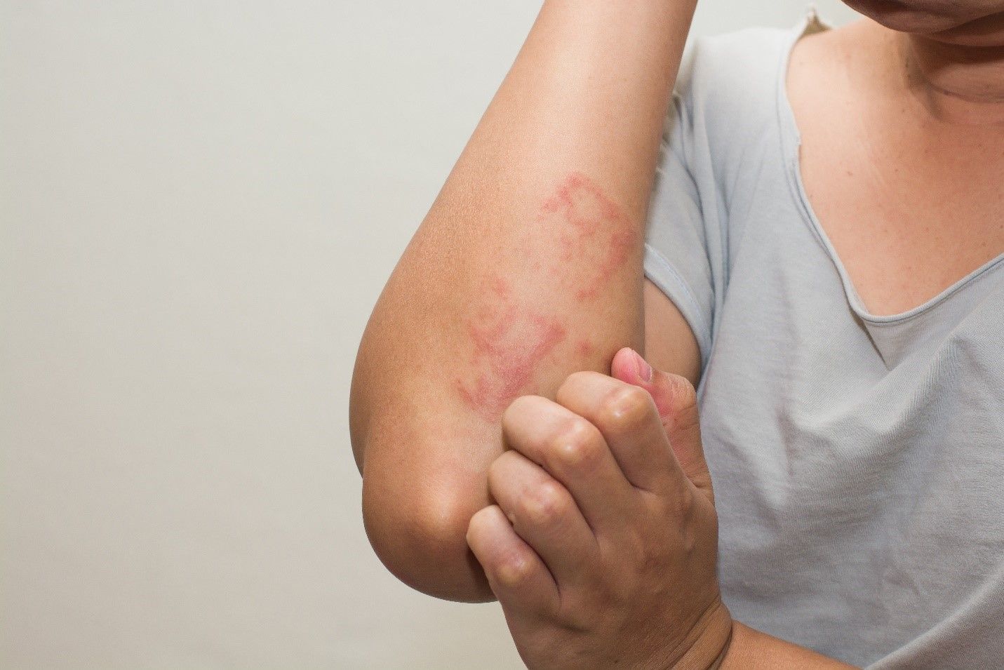 Sintomas de alergia - como reconhecer as principais reações alérgicas