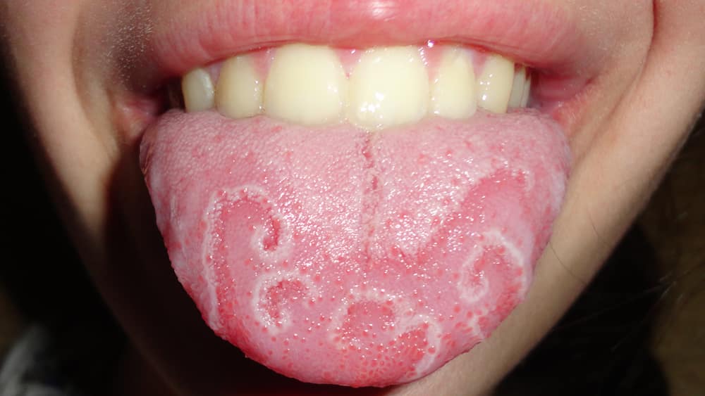 Doenças da língua - principais problemas de saúde no órgão da boca
