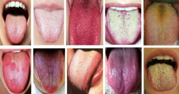 Doenças da língua - principais problemas de saúde no órgão da boca