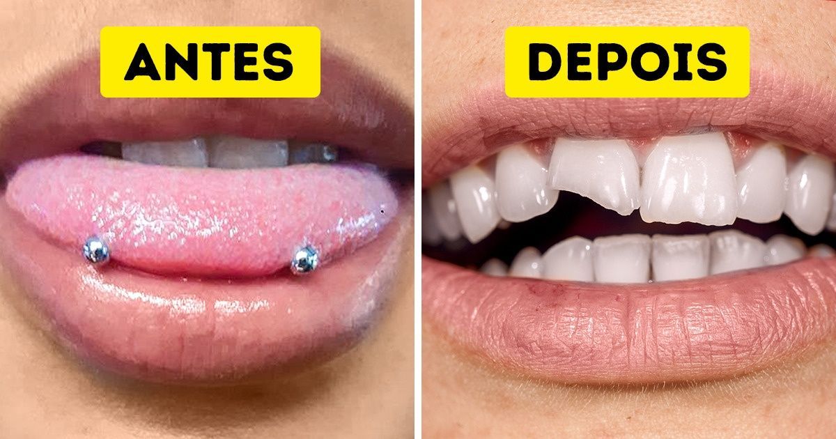 Tenho piercing na língua, posso colocar aparelho nos dentes?