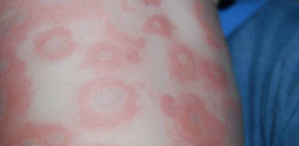 Alergia à água, o que é? O que pode causar e como tratar