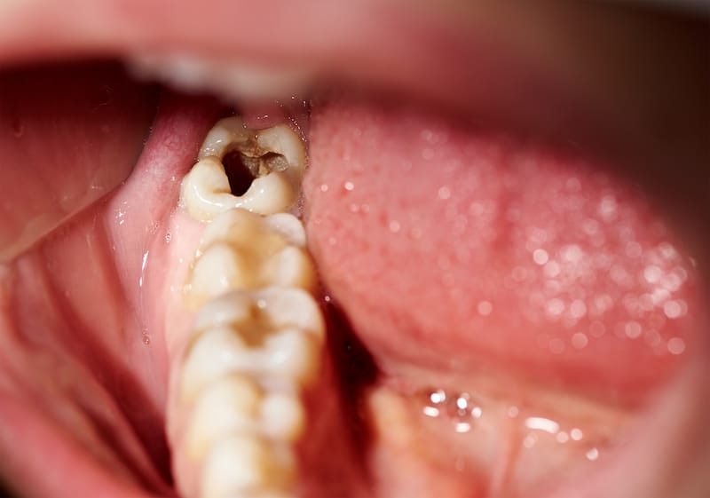 Dente cariado - principais sintomas e tratamentos para remoção