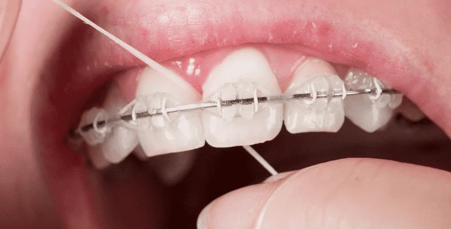 Fio dental - como usar corretamente e quais os principais tipos
