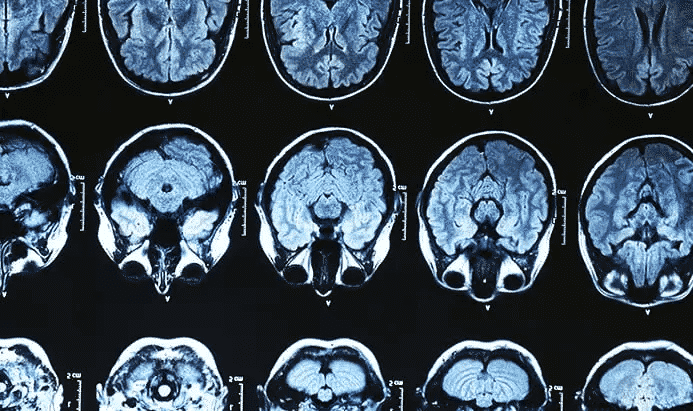 O que é Alzheimer - principais sintomas, causas e formas de tratamento