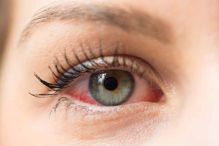 Olho vermelho - principais causas, variações e formas de tratamento
