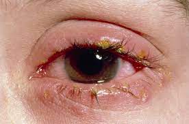Olho vermelho - principais causas, variações e formas de tratamento