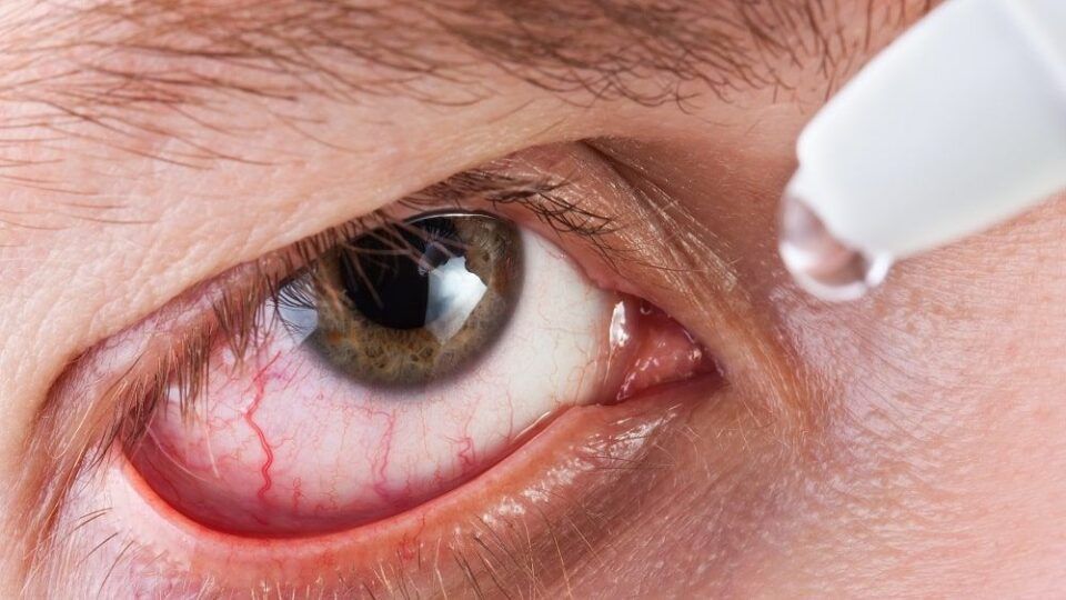 Remela, como são formadas? Causas de acúmulo nos olhos