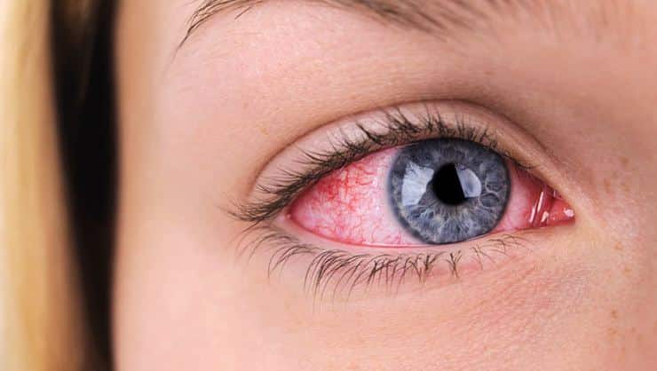 Remela - como são formadas e principais causas de acúmulo nos olhos