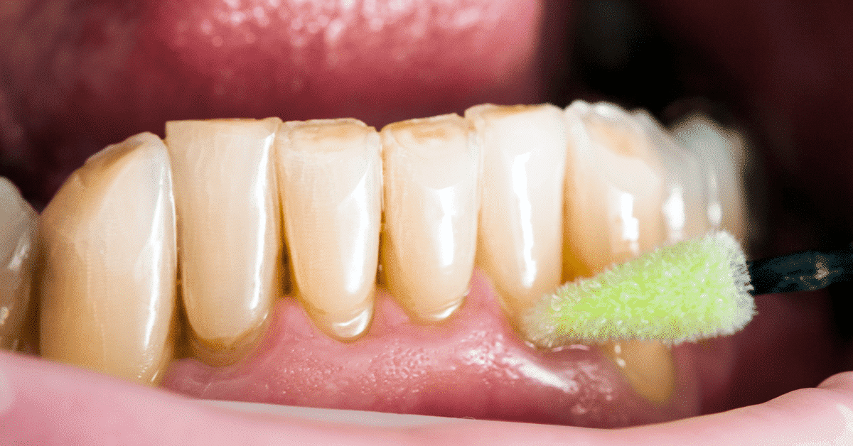 Mancha branca nos dentes - principais causas e formas de tratamento