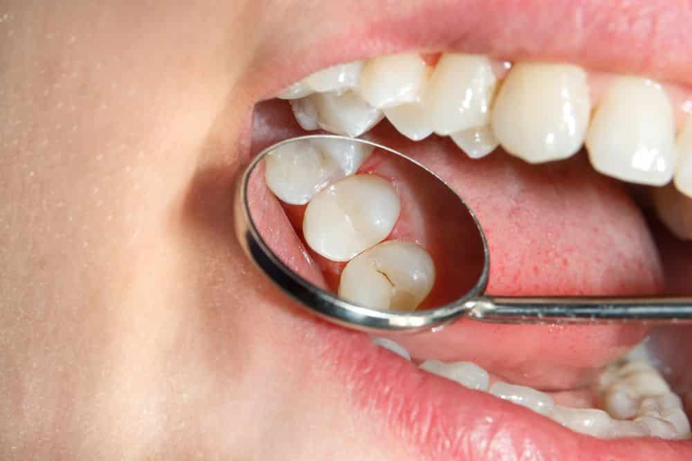 Mancha branca nos dentes - principais causas e formas de tratamento