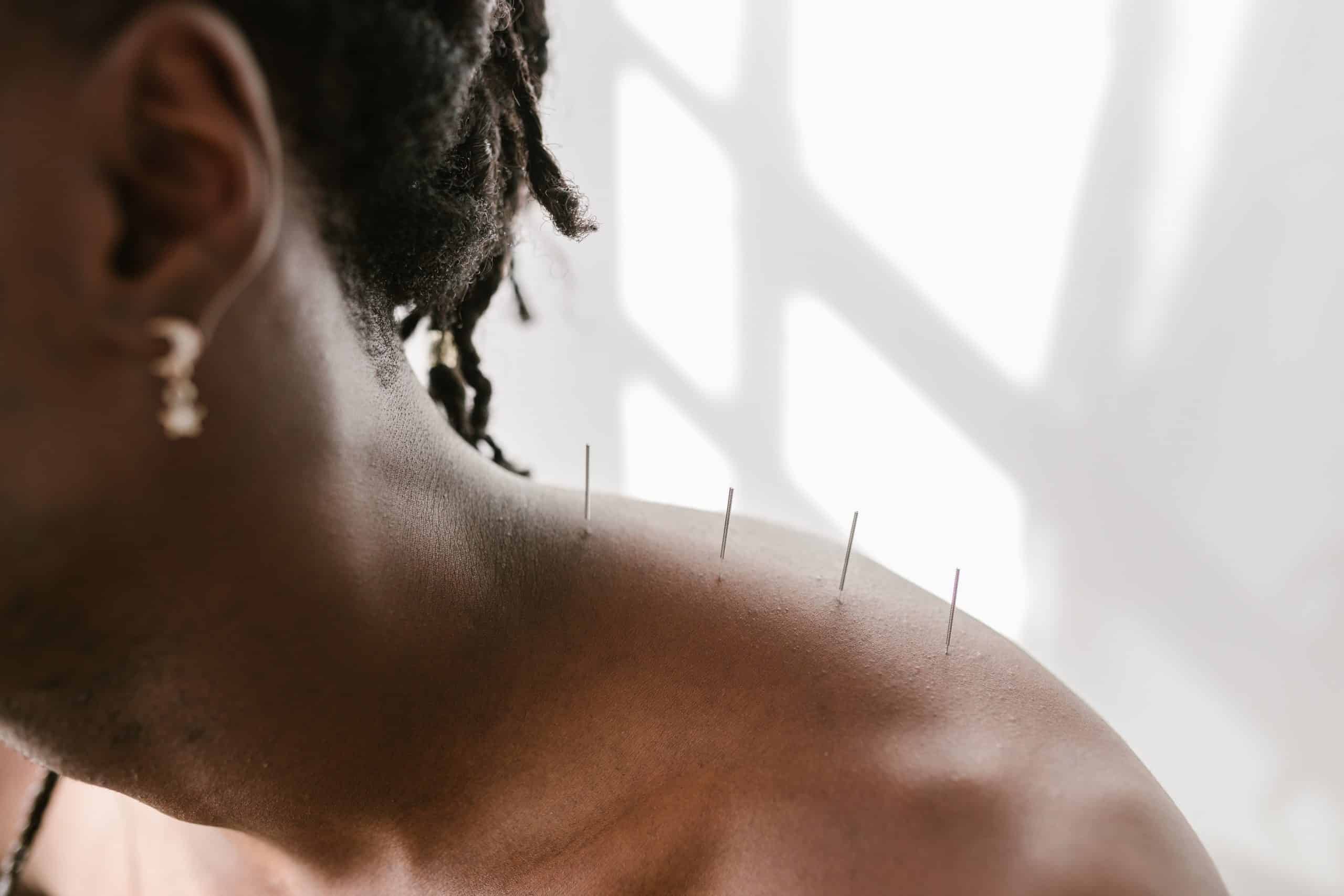 Fotografia de uma pessoa fazendo acupuntura