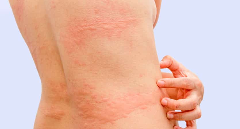 Alergia por estresse: principais sintomas e como tratar